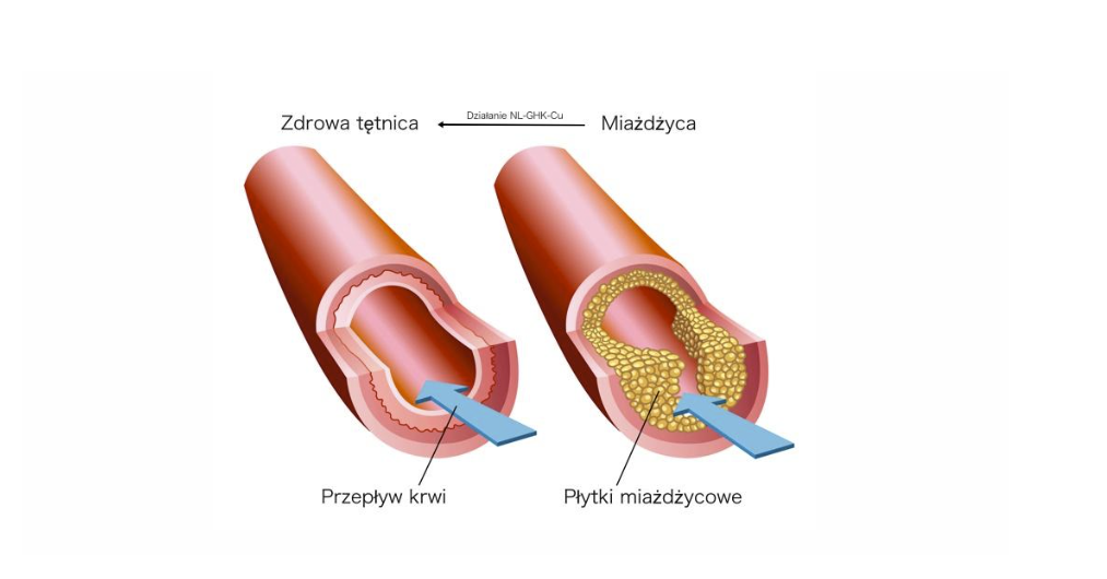 NL-GHK-Cu w profilaktyce często występujących chorób  takich jak m.in. miażdżyca tętnic, zaćma, cukrzyca, nefropatia czy choroba Alzheimera